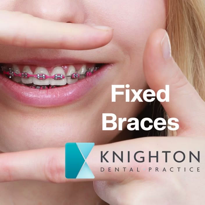 Fixed braces Knighton Dental Practice Dentist in Leicester, England