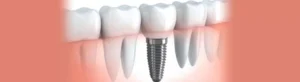 Dental implants Leicester Knighton Dental 