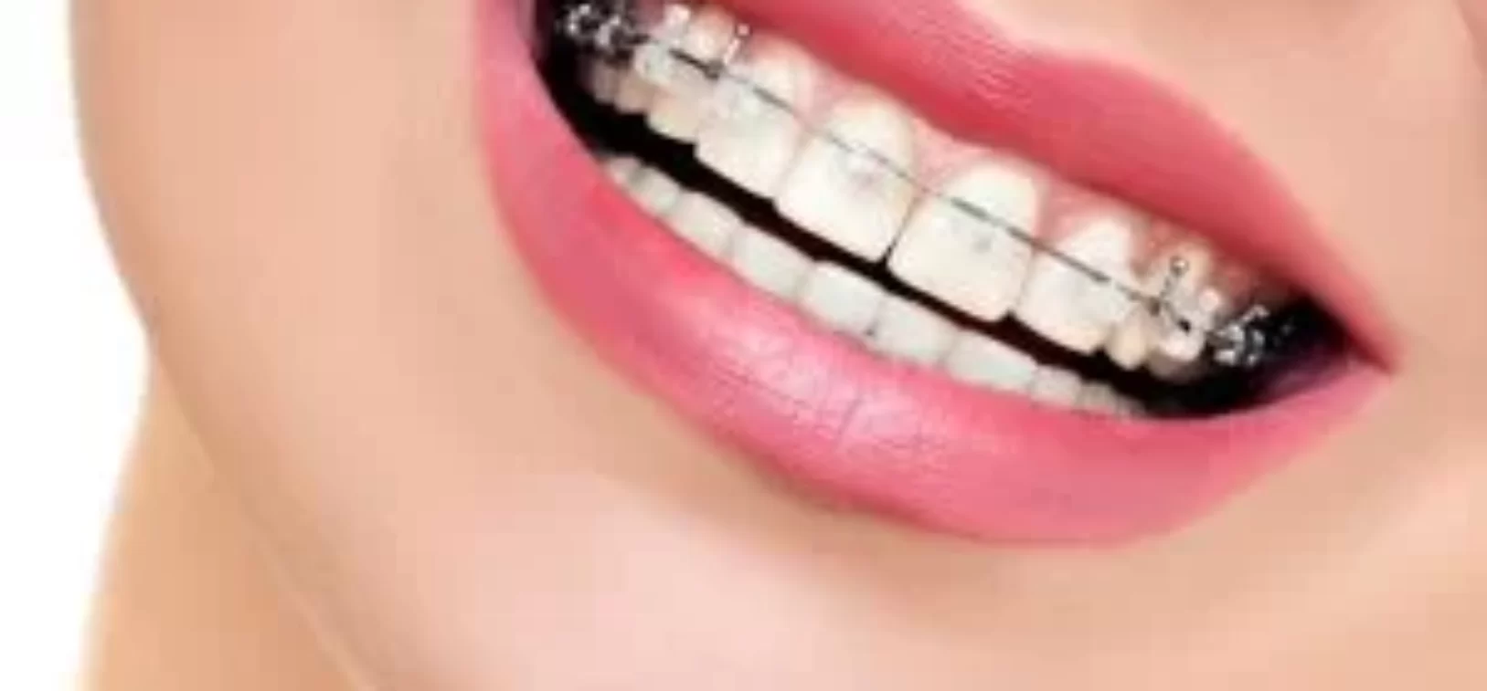 Braces Knighton Dental Leicester