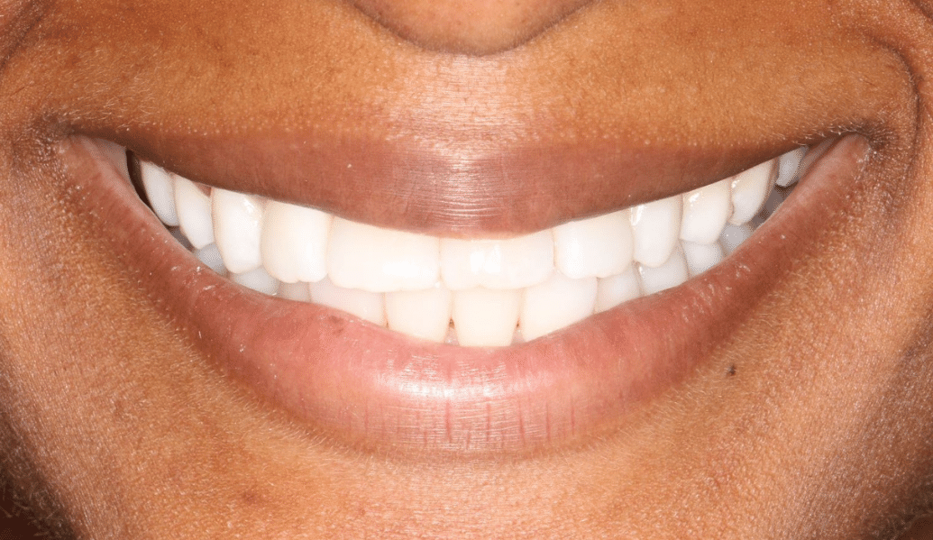 After - Knighton Dental