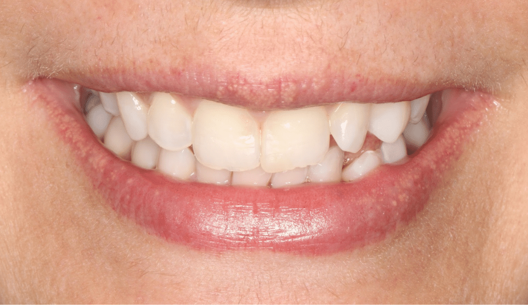 After - Knighton Dental