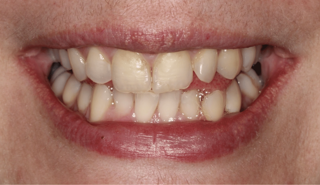 Before - Knighton Dental