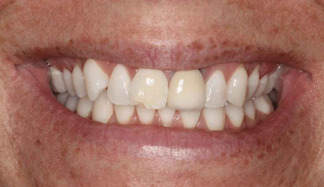 After - Knighton Dental