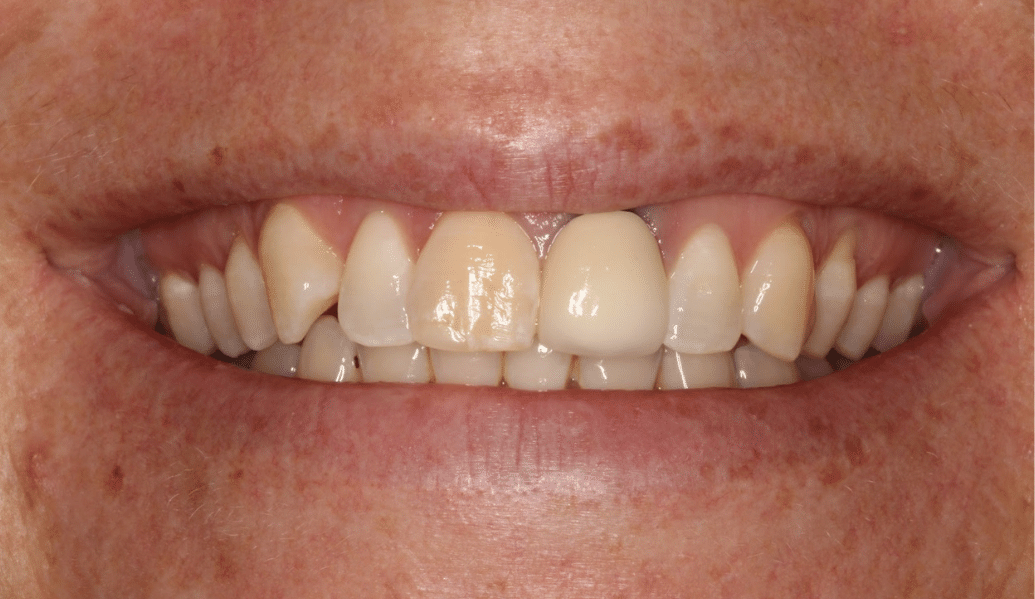 Before - Knighton Dental