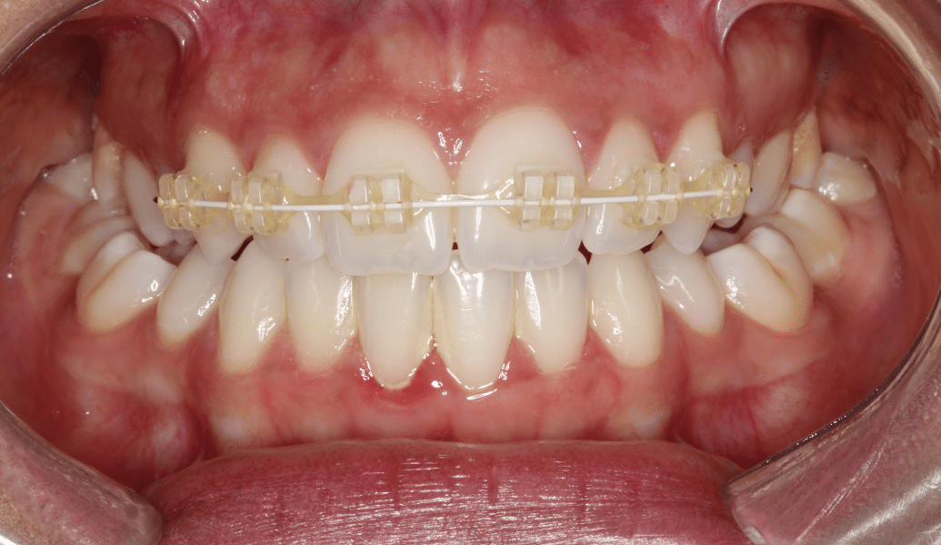 After - Knighton Dental