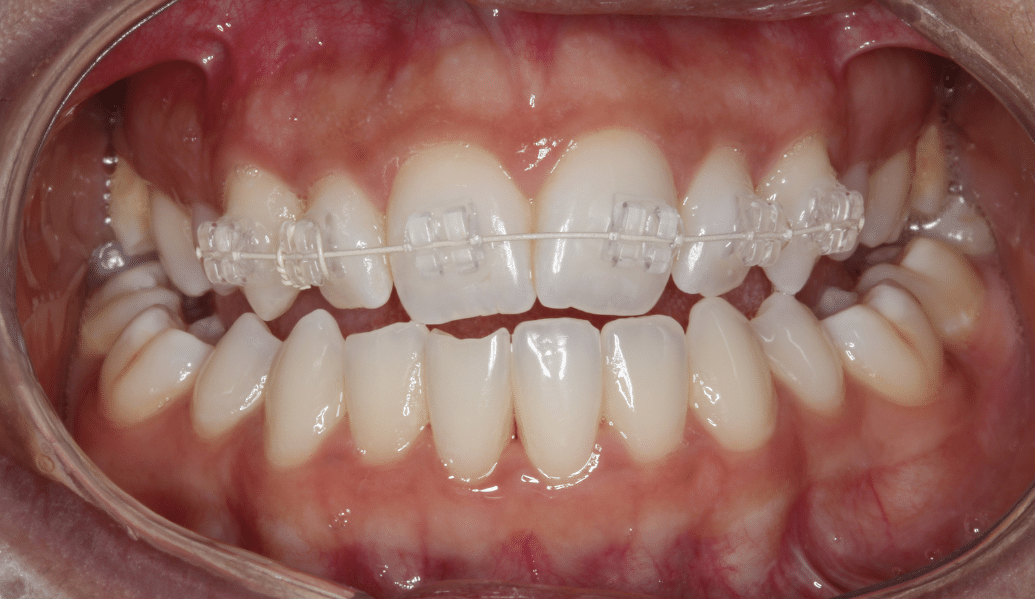 Before - Knighton Dental