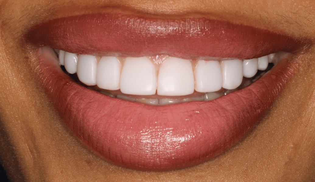 After - Knighton Dental