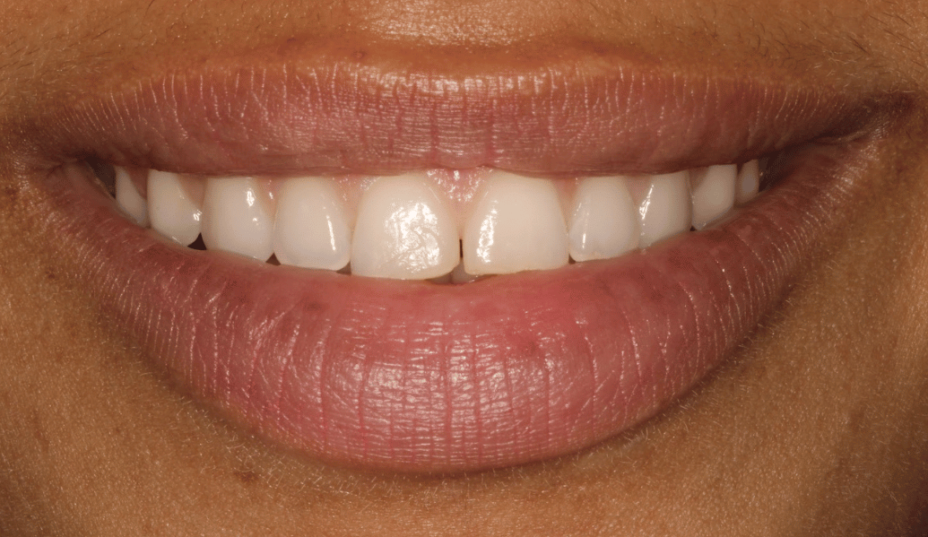 Before - Knighton Dental