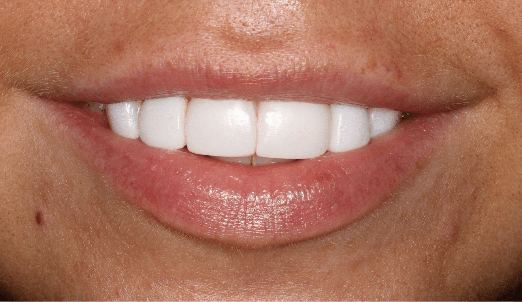 After - Knighton Dental