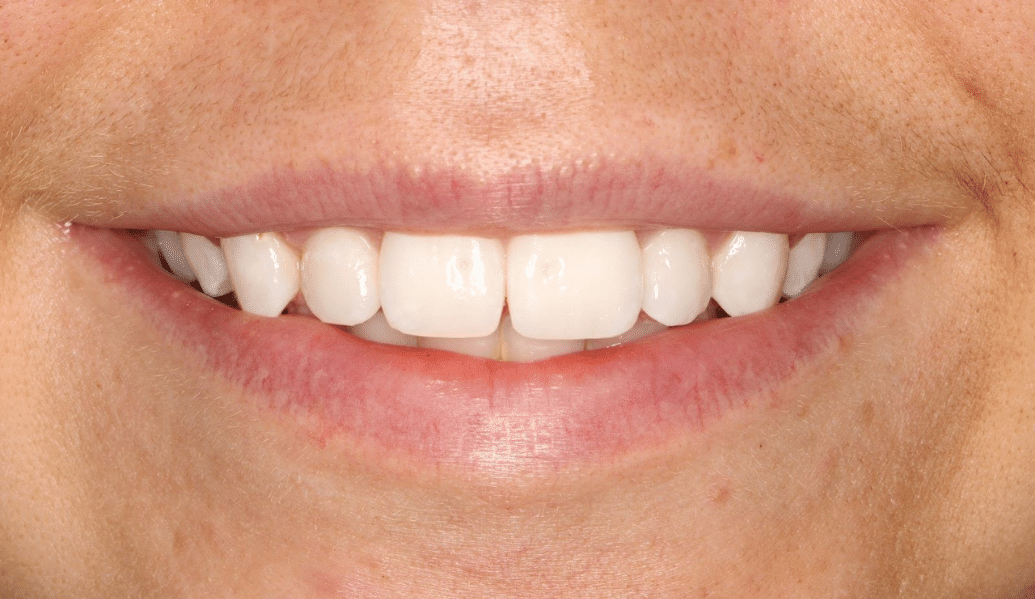 Before - Knighton Dental