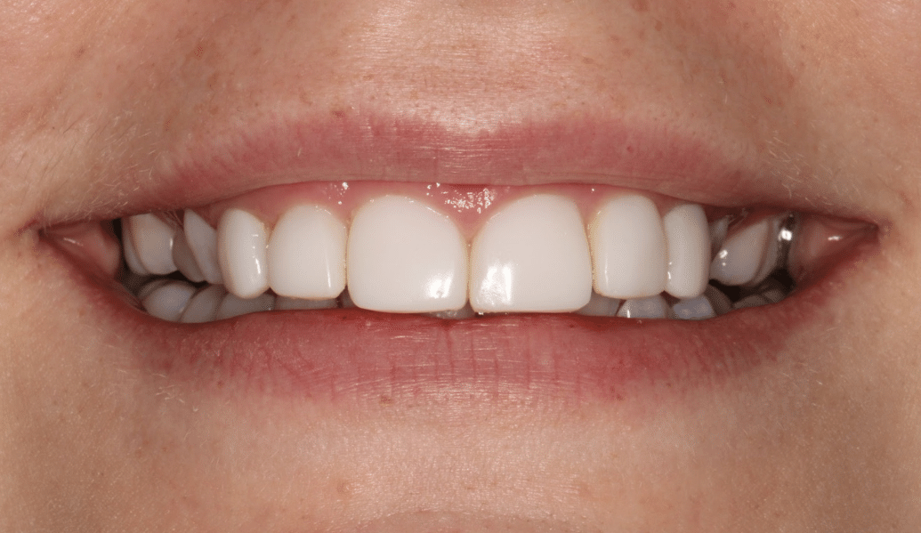 After - Knighton Dental