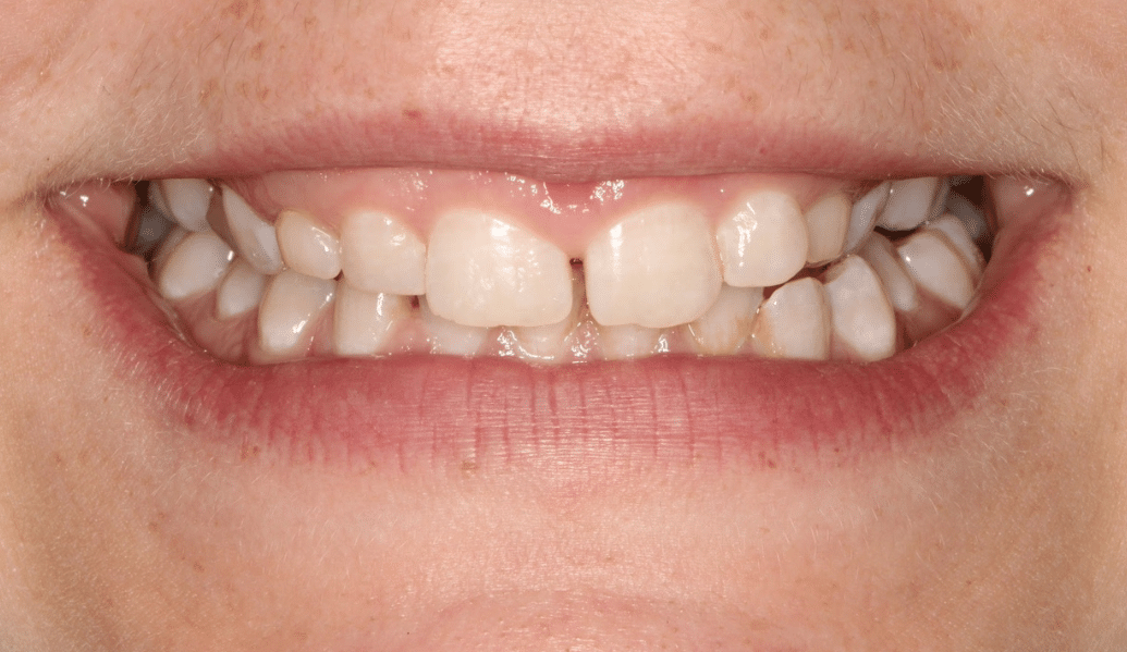 Before - Knighton Dental