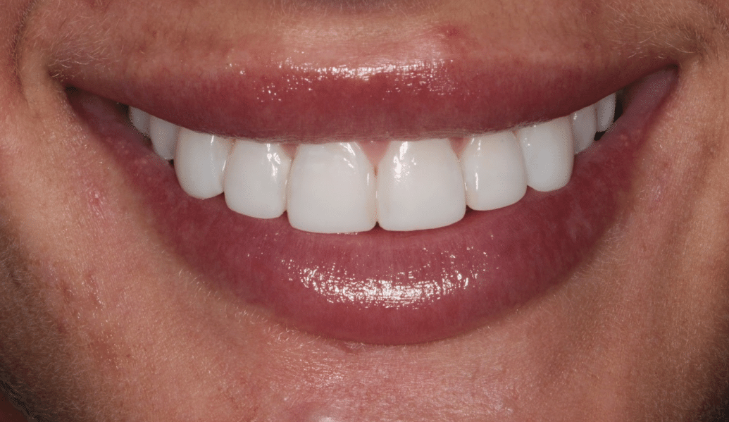 After - Knighton Dental