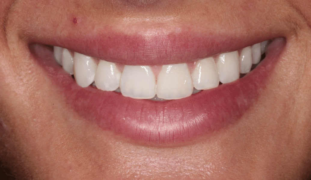 Before - Knighton Dental