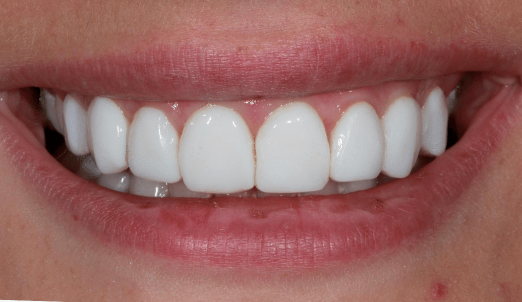 After - Knighton Dental