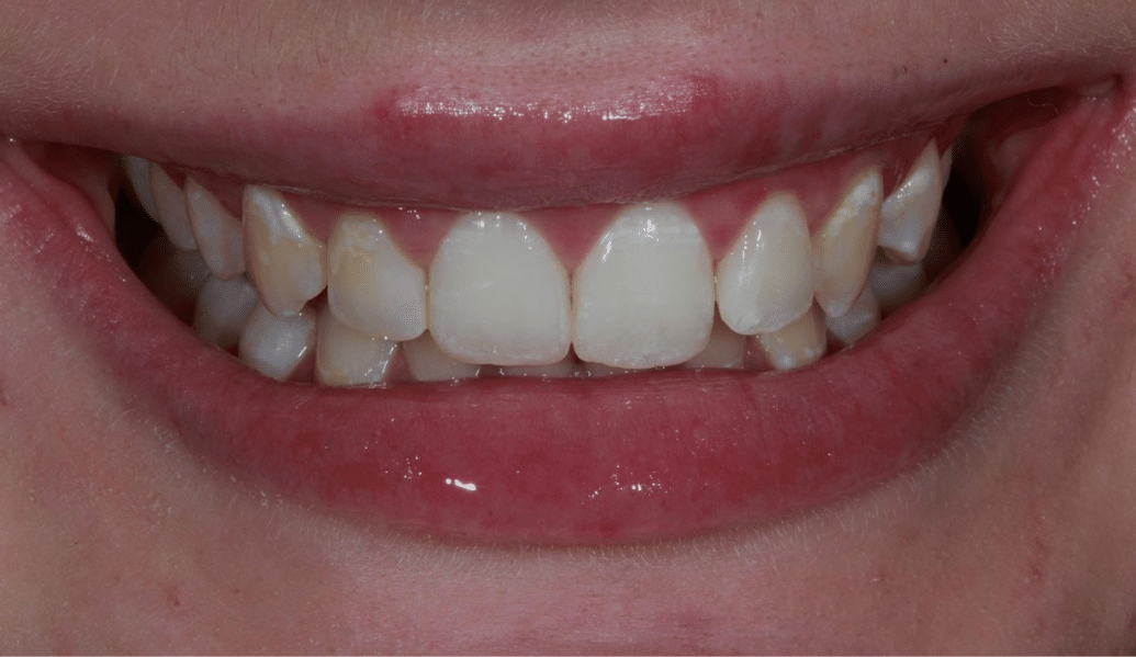 Before - Knighton Dental