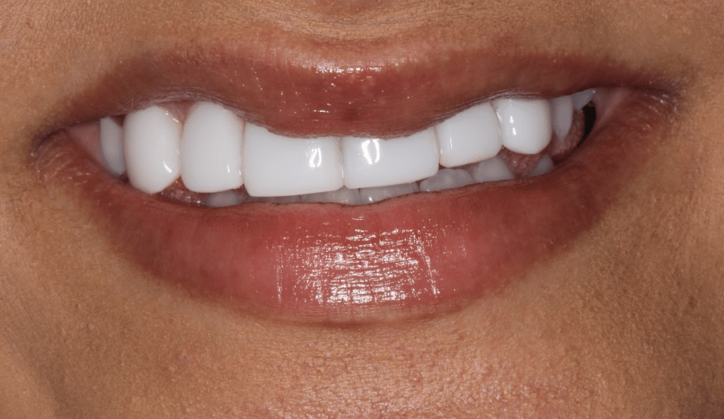 After - Knighton Dental