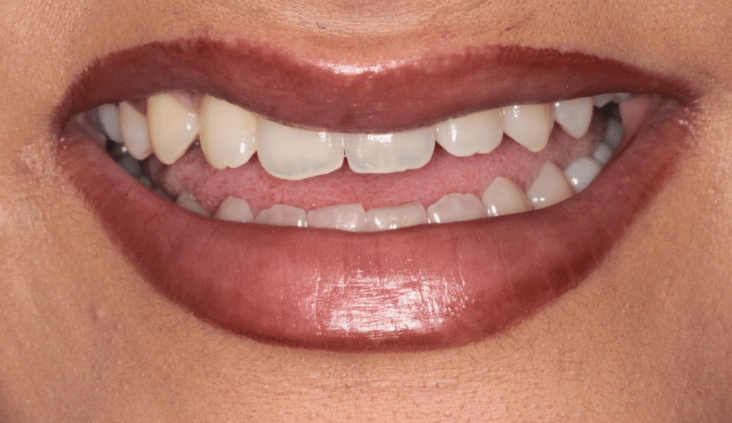 Before - Knighton Dental