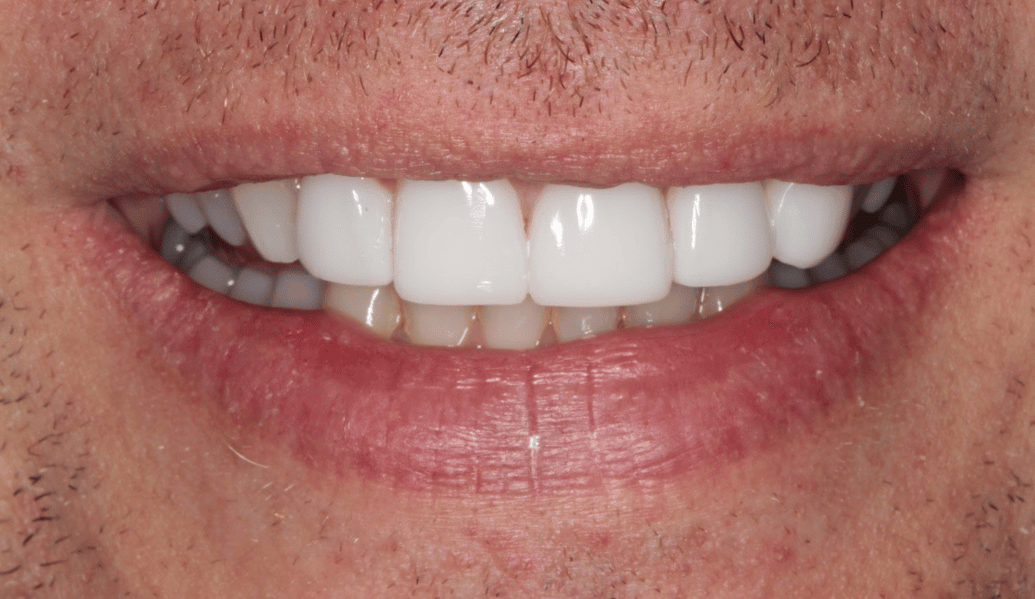 After - Knighton Dental