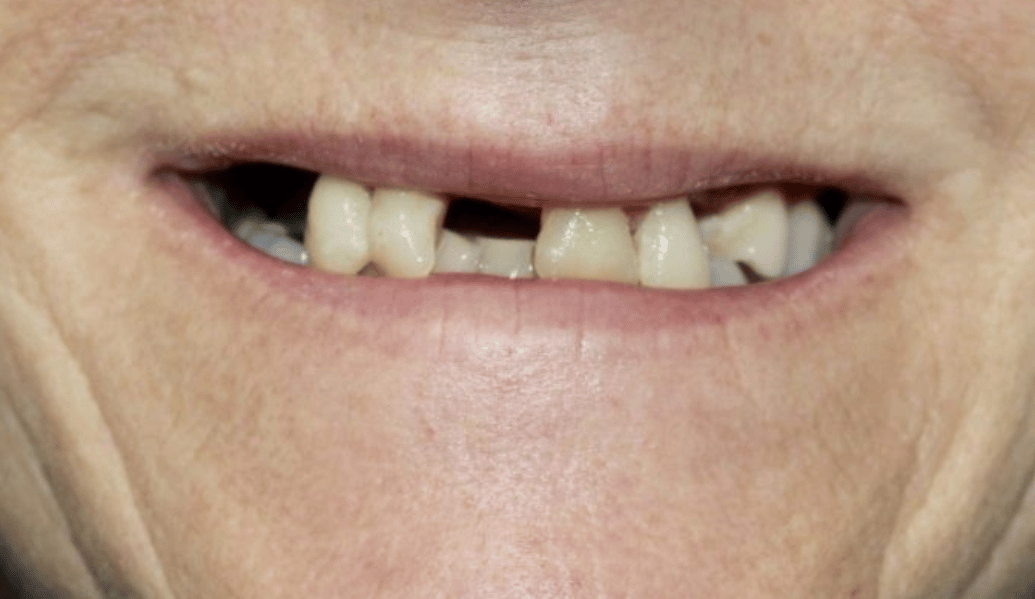 Before - Knighton Dental