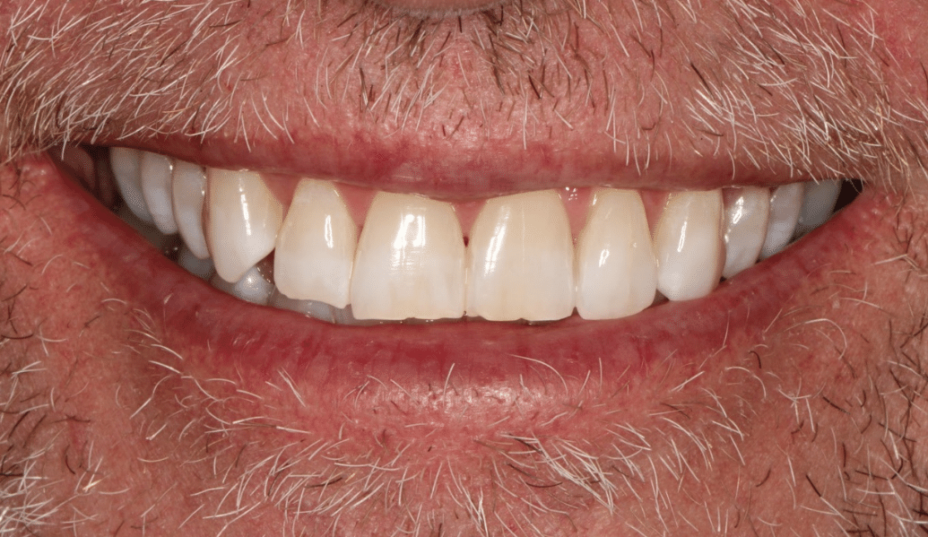 After - Knighton Dental