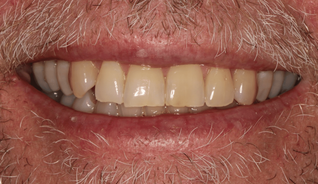 Before - Knighton Dental