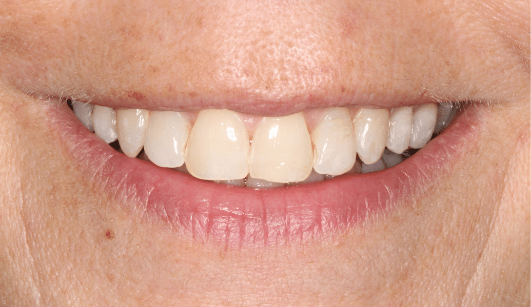 Before - Knighton Dental