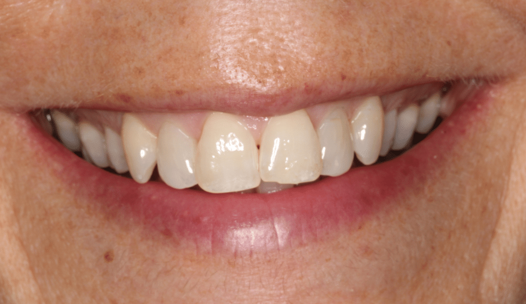 After - Knighton Dental