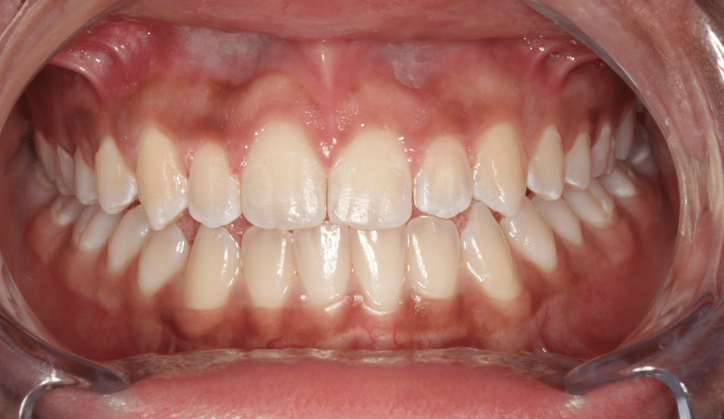 After - Knighton Dental