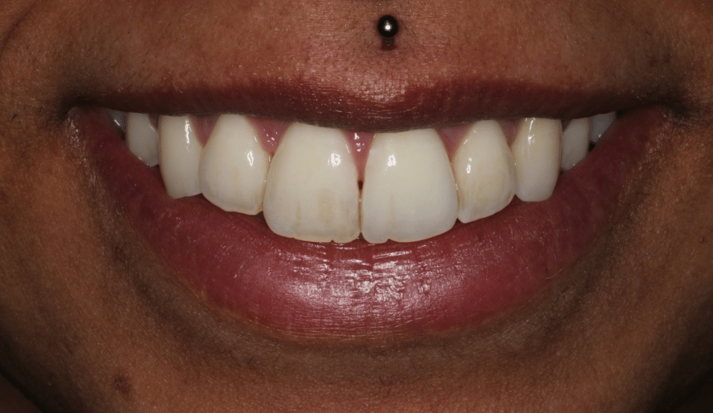 After - Knighton Dental