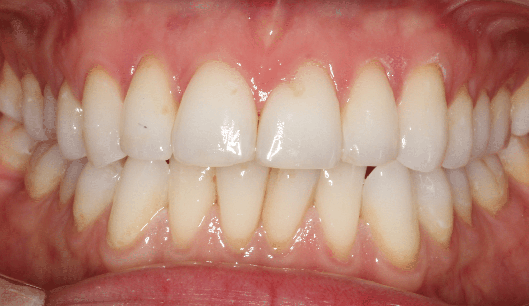 After - Knighton Dental