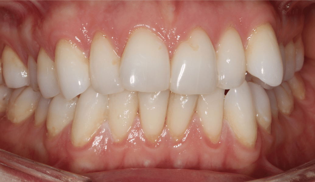 Before - Knighton Dental