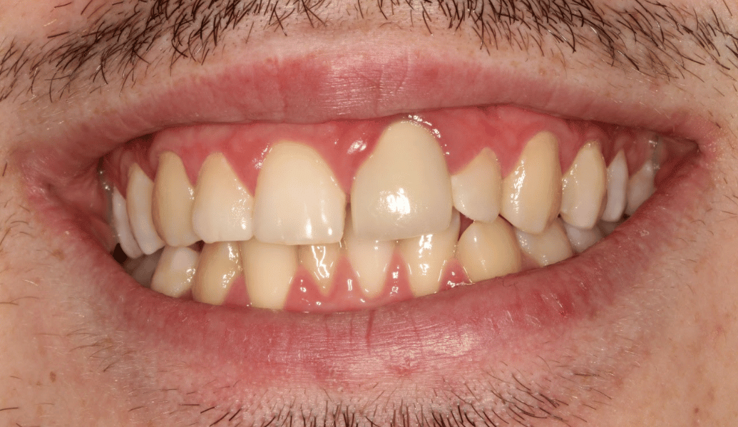 Before - Knighton Dental