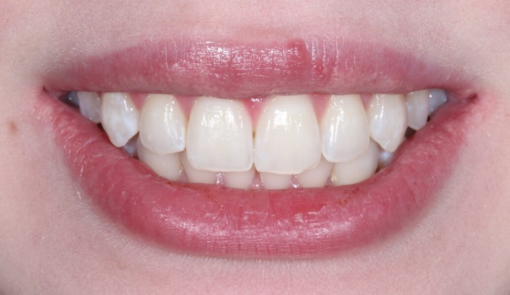 After - Knighton Dental