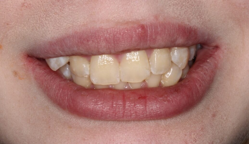 Before - Knighton Dental