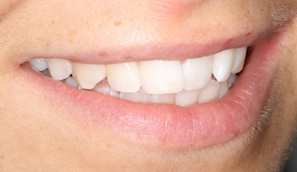 Before - Knighton Dental