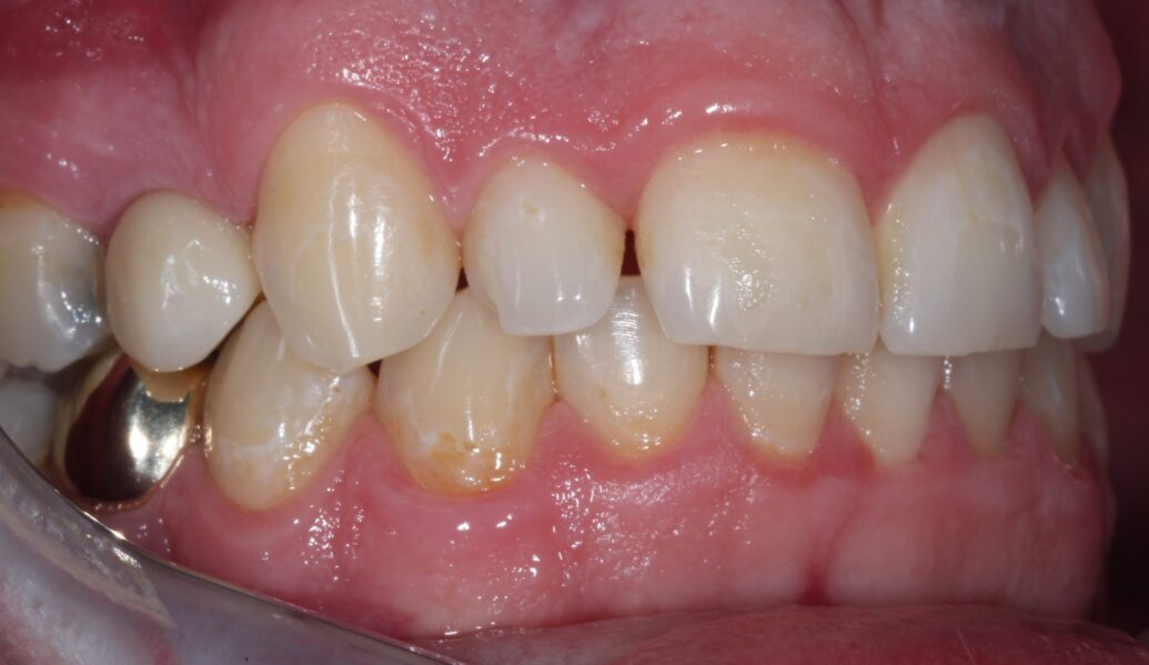 After - Knighton Dental