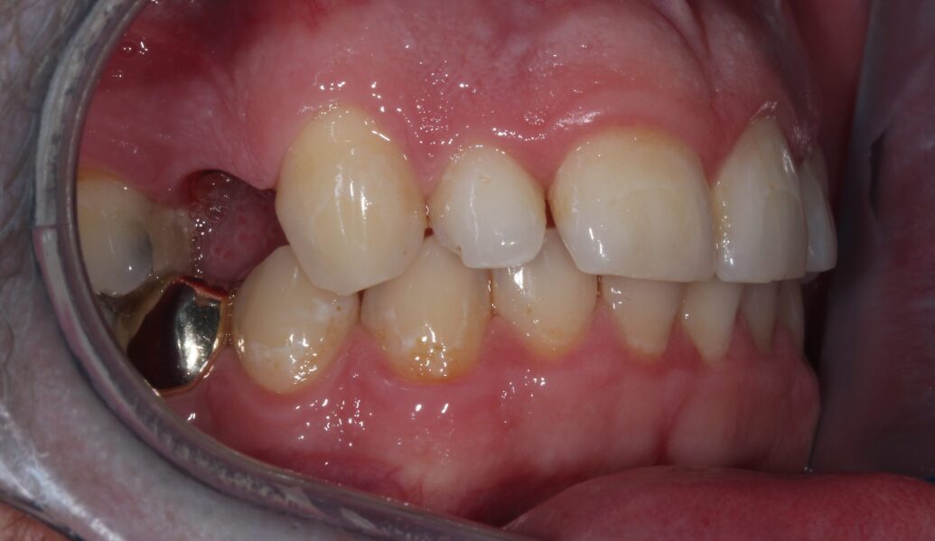 Before - Knighton Dental