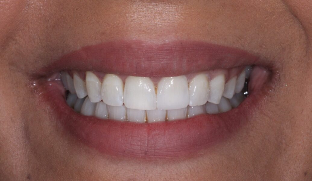 After - Knighton Dental