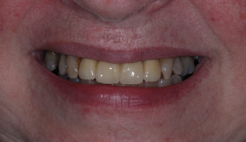 After - Knighton Dental