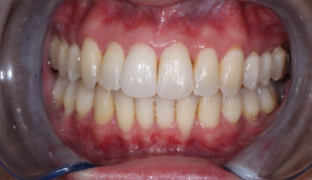 After - Knighton Dental