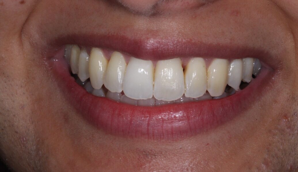 After Invisalign After - Knighton Dental