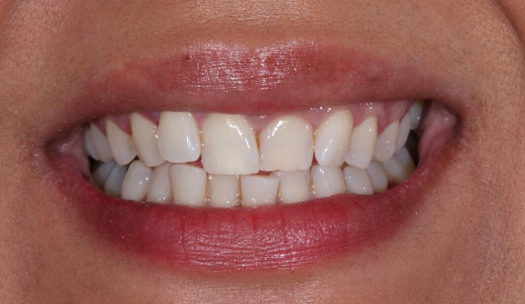 Before - Knighton Dental