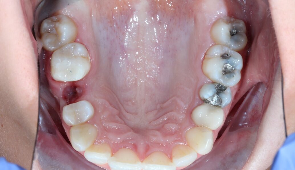 Before - Knighton Dental