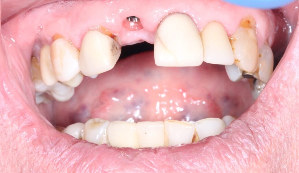 Before - Knighton Dental