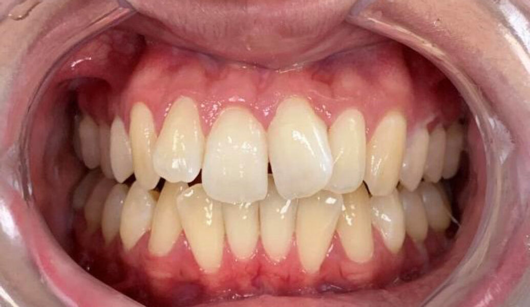 Before - Knighton Dental
