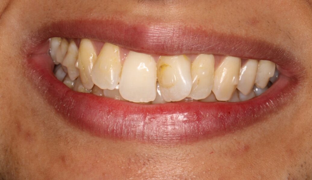 Before Invisalign Before - Knighton Dental