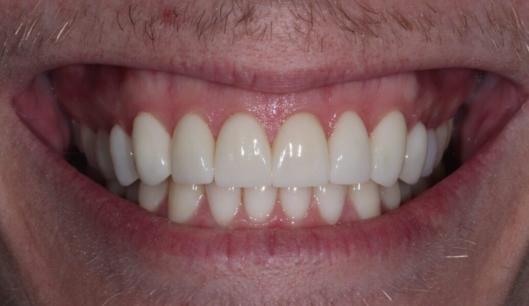 After - Knighton Dental