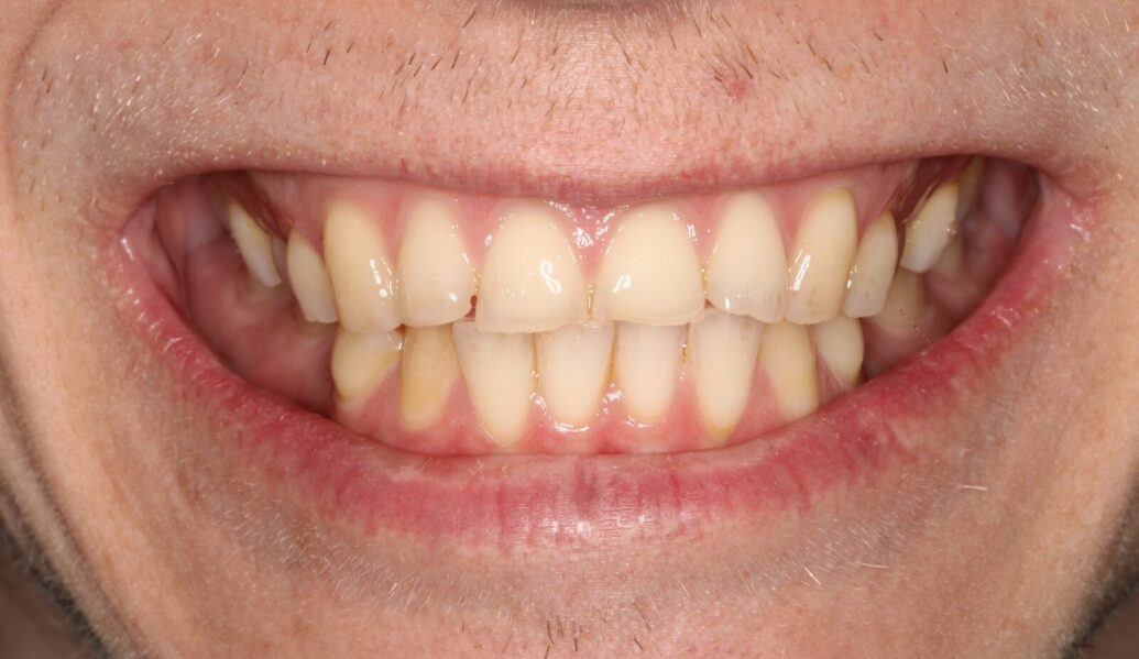 Before - Knighton Dental