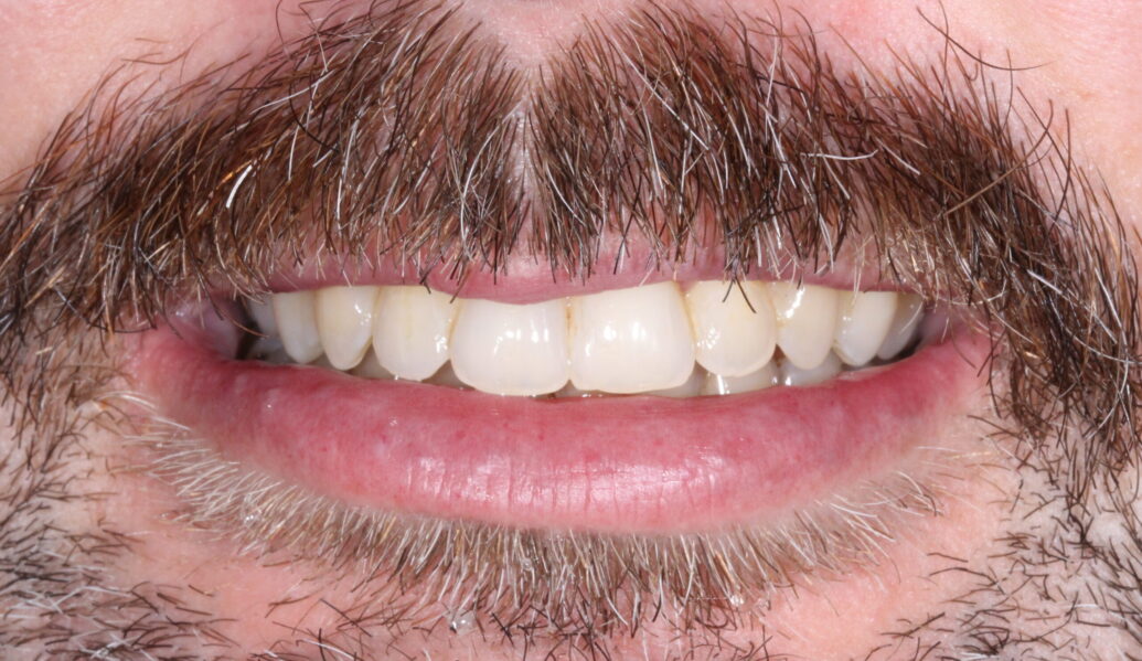 After - Knighton Dental